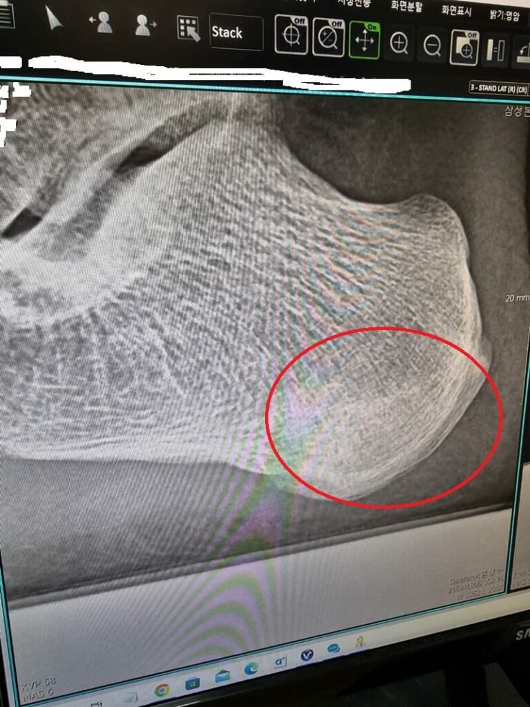 종골골절-X-ray사진